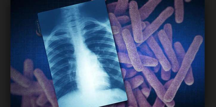 Apa itu Tuberculosis? 5 Cara Sembuh Dari Penyakit Ini